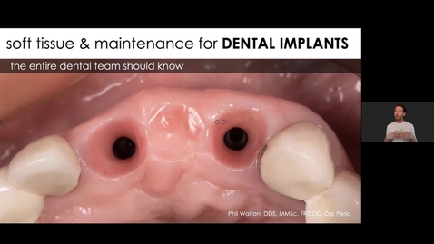 Thumbnail for Implant Maintenance The Entire Dental Team Must Know - Dr. Walton